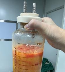 玉溪水动力吸脂手术要做多久？